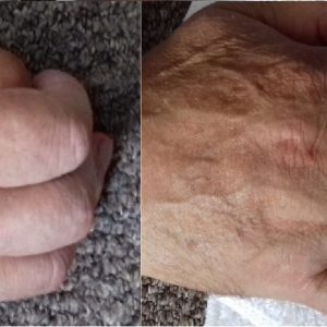 hand stroke before after september 2017